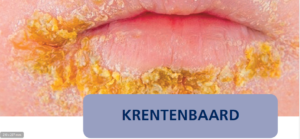 Krentenbaard