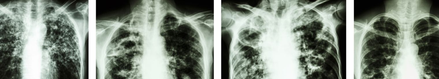 Tuberculose
