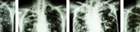 Tuberculose